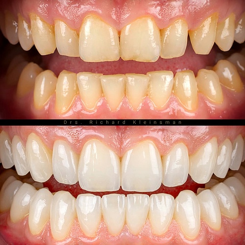 26 non-prep veneers & facelays for a perfect smile after grinding, preserving the patient’s unique identity....