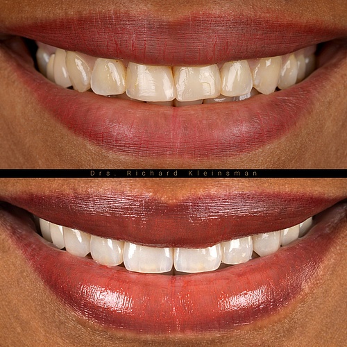 Complete smile transformation with 12 non-prep veneers for the upper jaw and 14 veneers and facelays for the lower jaw,...