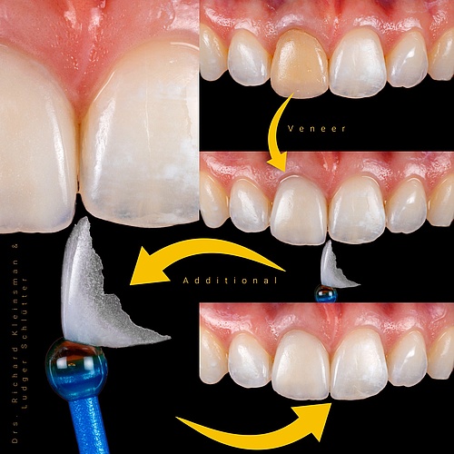 Optimizing form and color with a ceramic chip and veneer combination. . . Dentist: @drs.richardkleinsman Technician:...