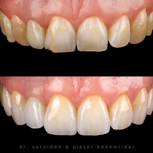 Check out the impressive results of a treatment with veneers and dental crowns. A radiant smile makes all the...