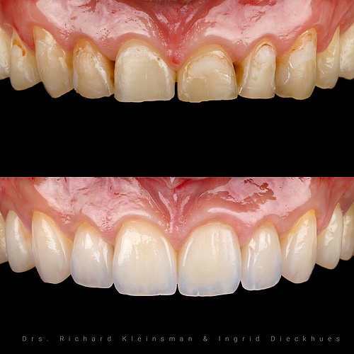 This image showcases the remarkable transformation of a smile using 12 thin veneers. This minimally invasive technique...