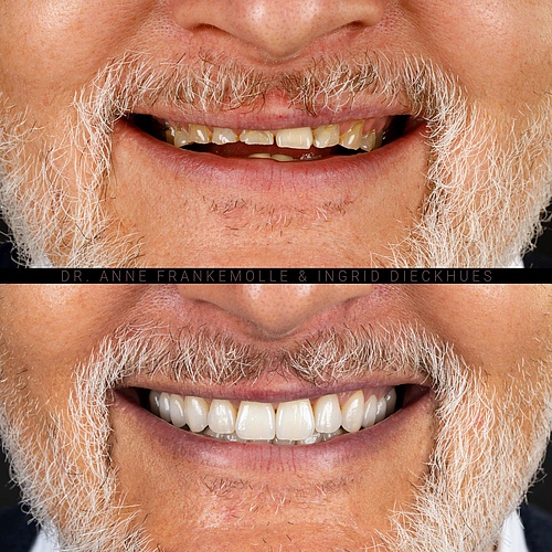 Smile Transformation Alert! Swipe to see the incredible before and after of our latest smile makeover using zirconium...