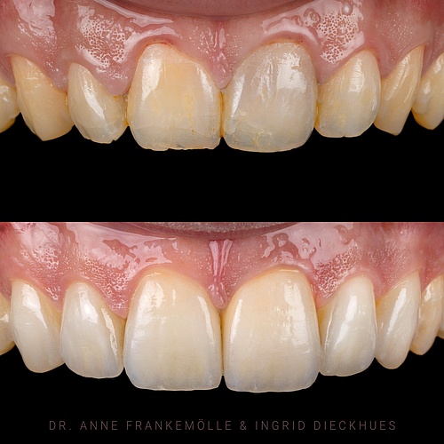 Harmonious and more masculine result by adjusting the length, colour and shape of the front teeth and optimising the...