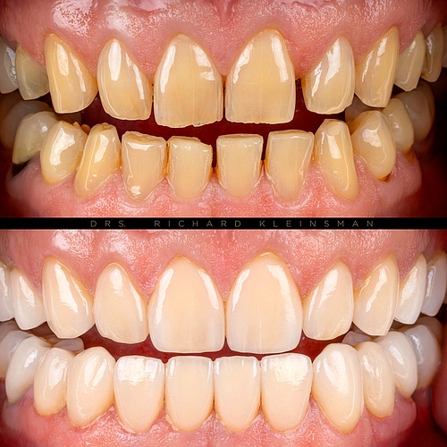 Complete renovation of upper and lower jaw using facelays and non-prep veneers without damaging the teeth, combined with...